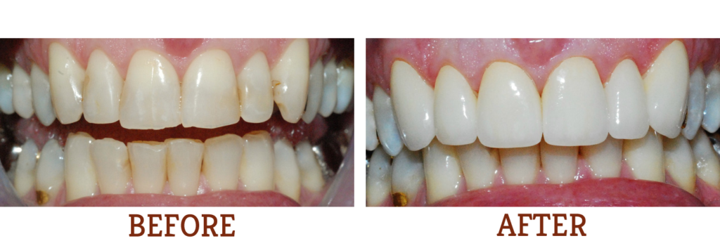 Before and After images of teeth