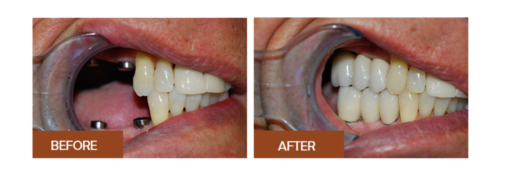 Before and After images of teeth