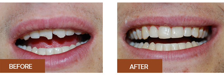 Before and After images of teeth