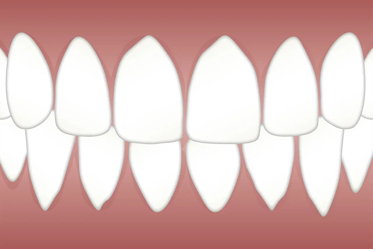 periodontal scaling and root planing