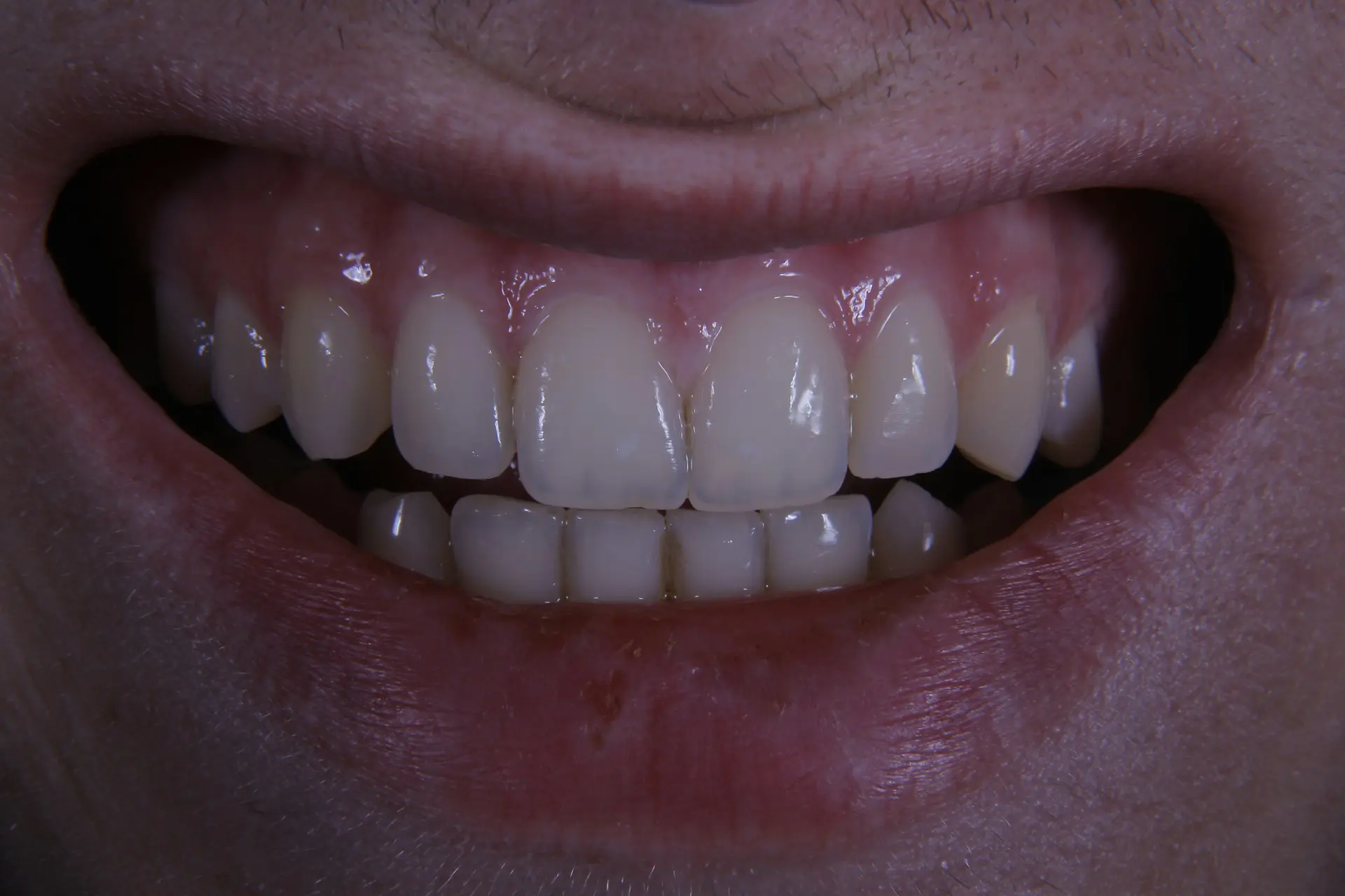 big smile with teeth showing