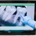 Gloved hand pointing to tooth roots on a dental x-ray