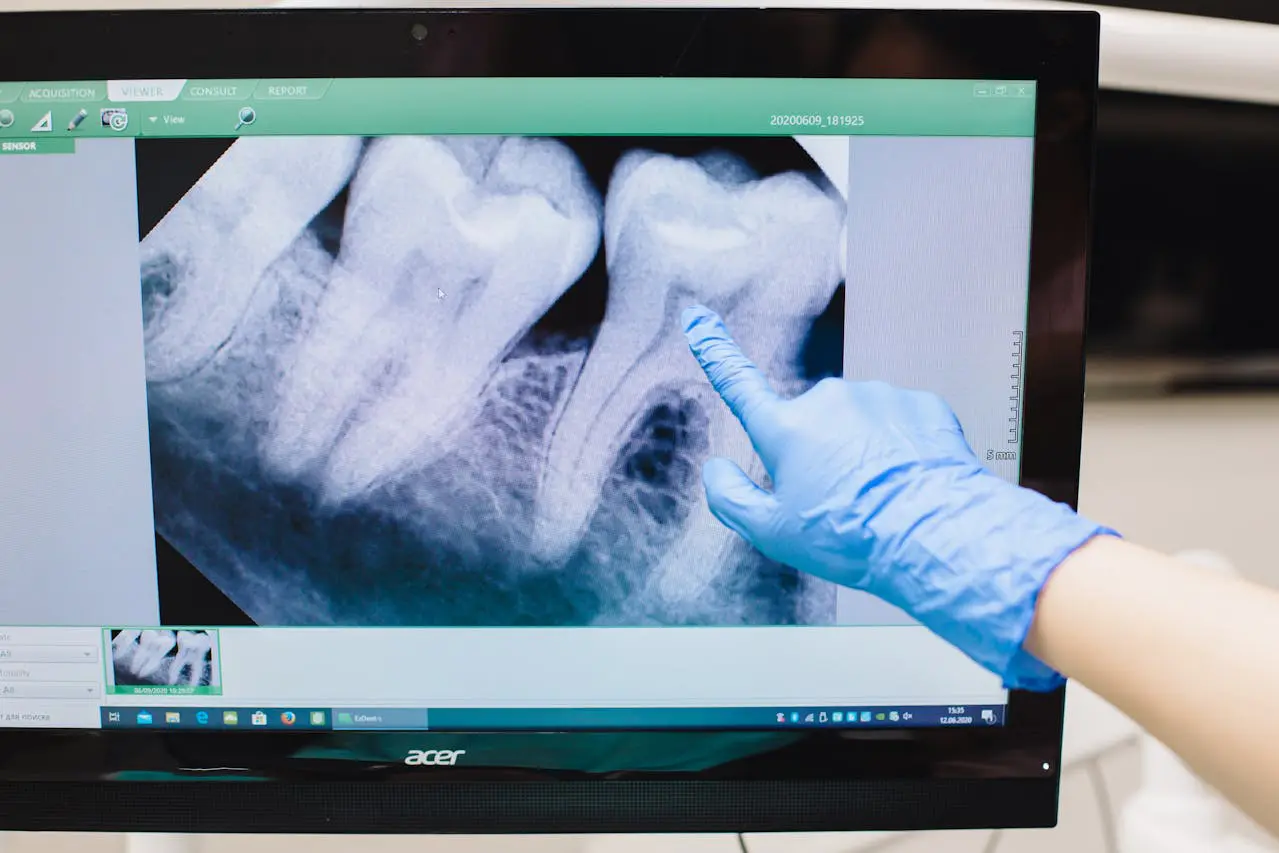 Gloved hand pointing to tooth roots on a dental x-ray