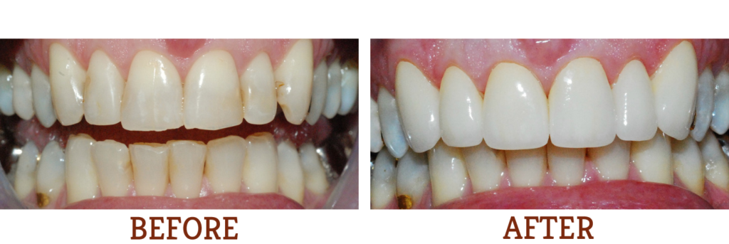 Before and After images of teeth
