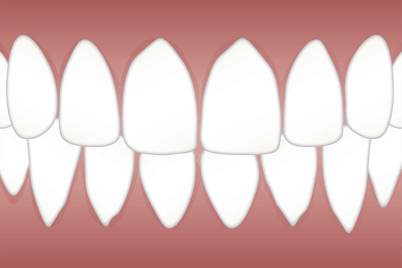 periodontal scaling and root planing