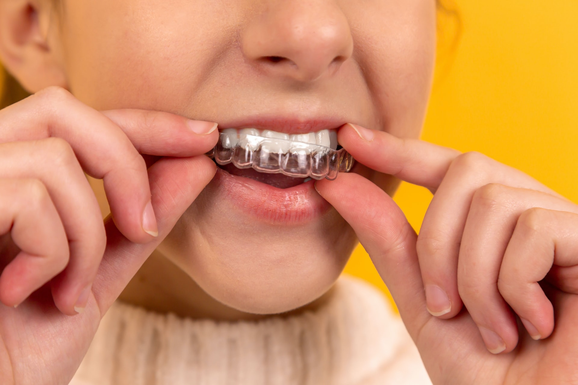 Why You May Need Invisalign Attachments