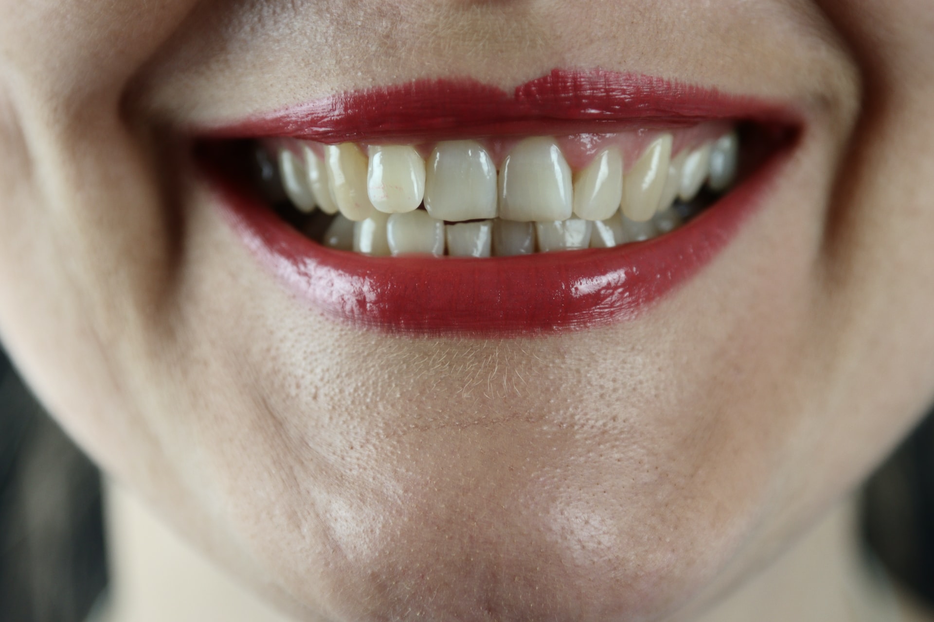 picture of teeth, with discolored teeth - whitening a dead tooth