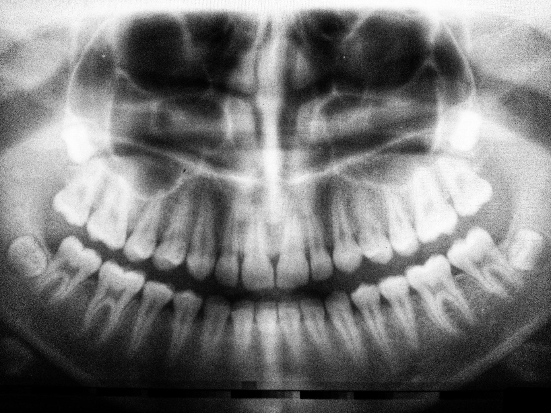 x-ray of teeth - types of human teeth