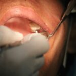 oral cancer