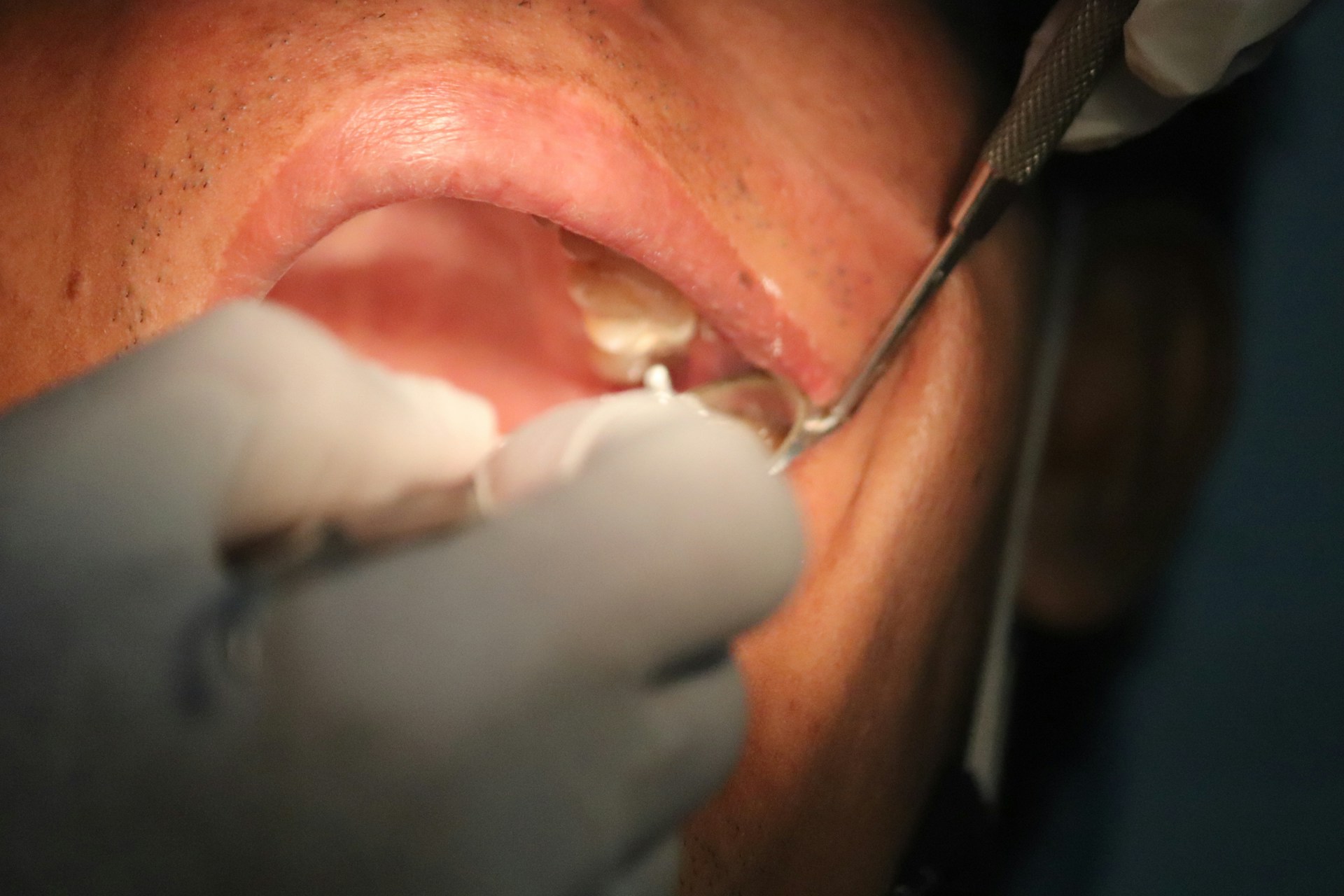 oral cancer
